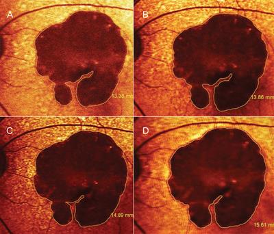 The role of dual antiplatelets in geographic atrophy secondary to non-neovascular aged-related macular degeneration